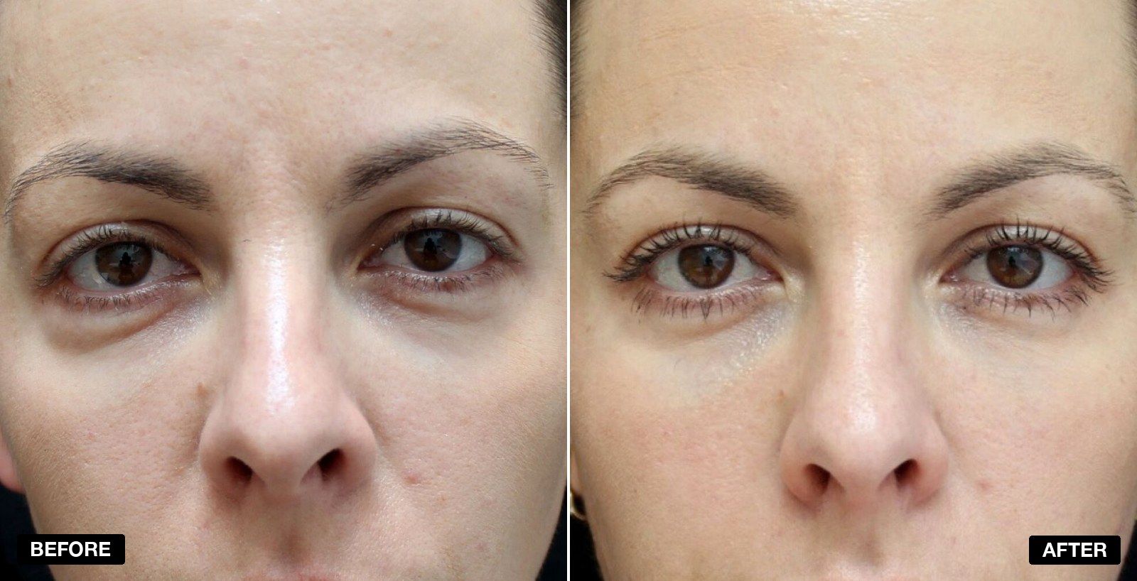 Tear Trough filler before and after - patient case 12 of 13 at PHI Clinic London