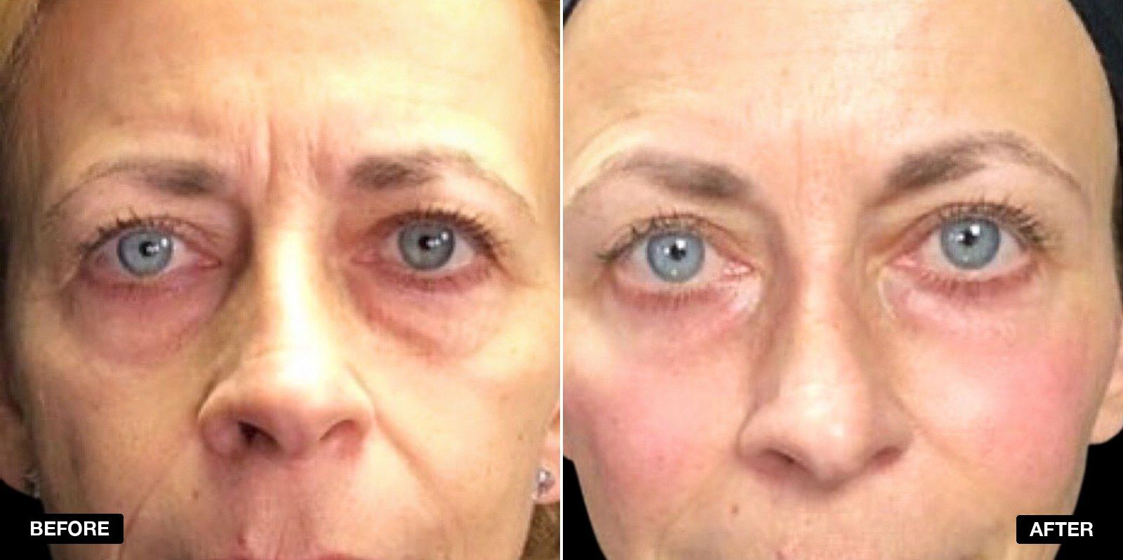 Tear Trough filler before and after - patient case 13 of 13 at PHI Clinic London