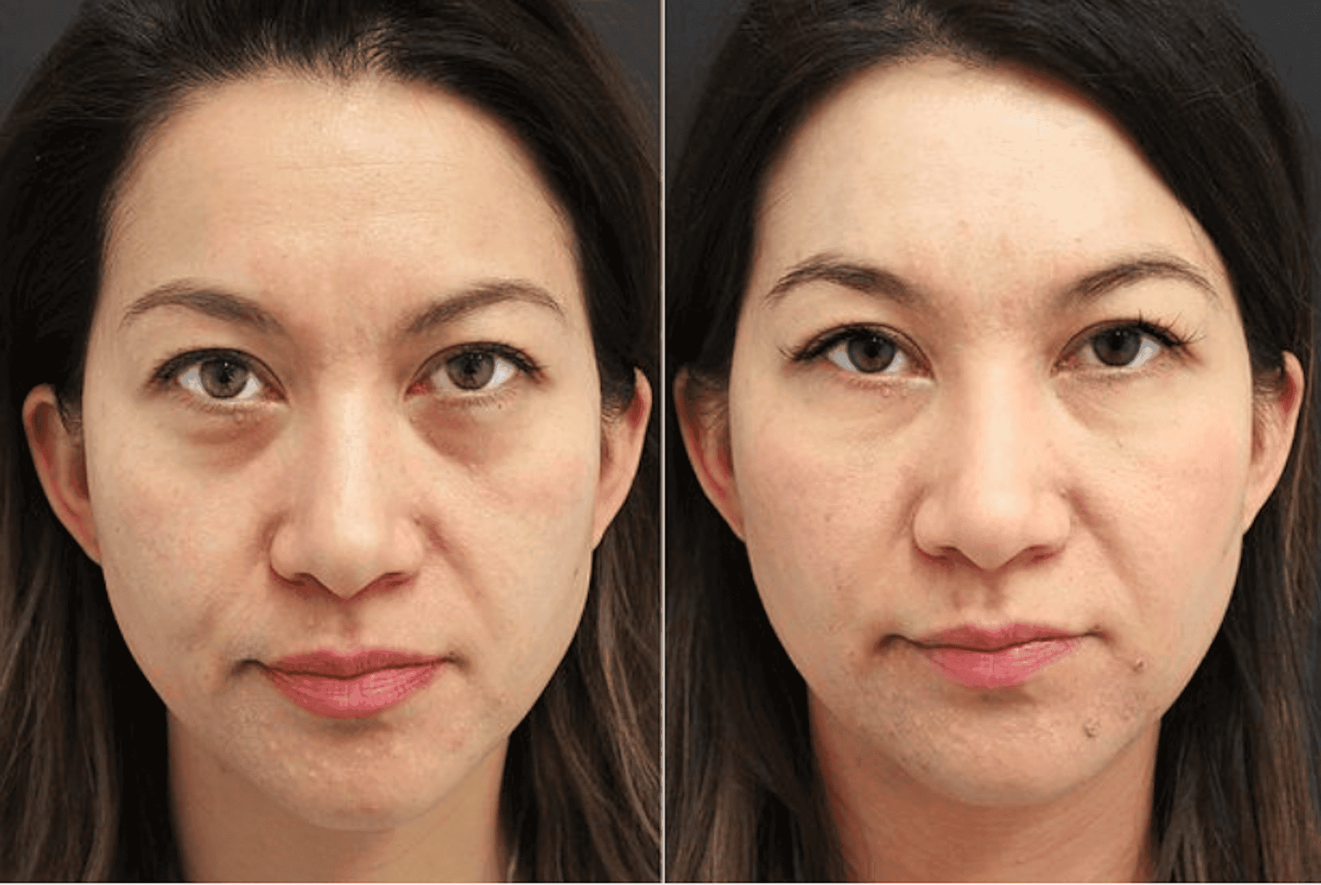 tear trough treatment non-surgical london