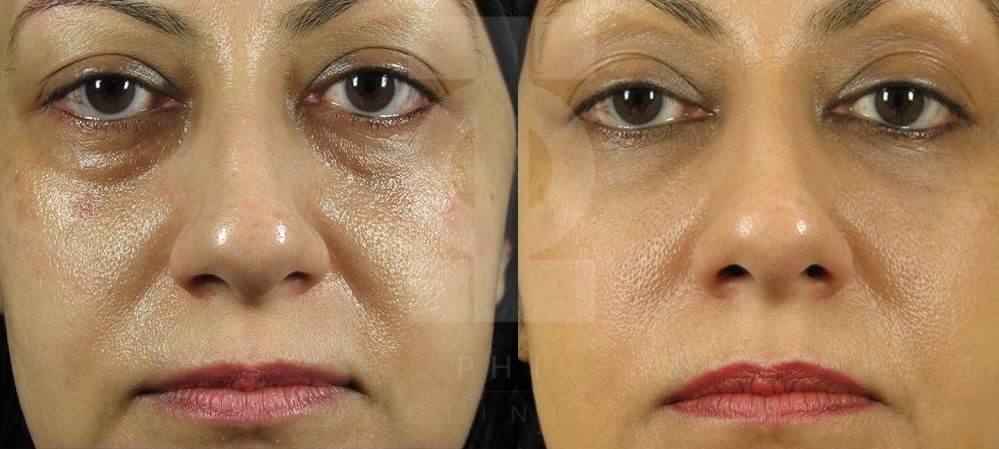 tear trough with dermal fillers eyes