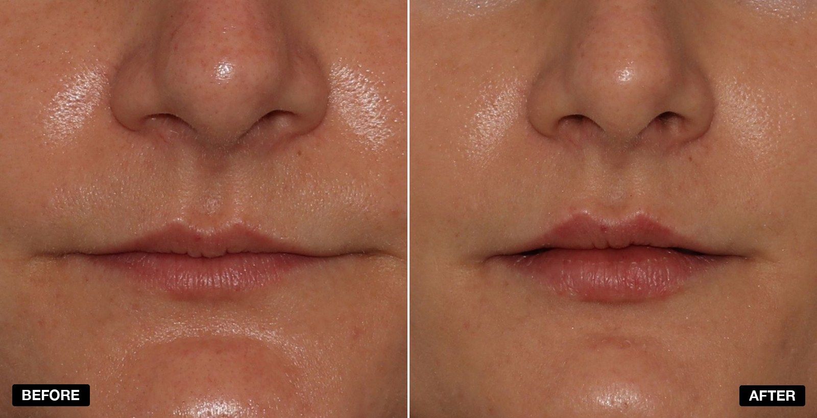 Thin lips transformations - patient case 1 of 1 at PHI Clinic London