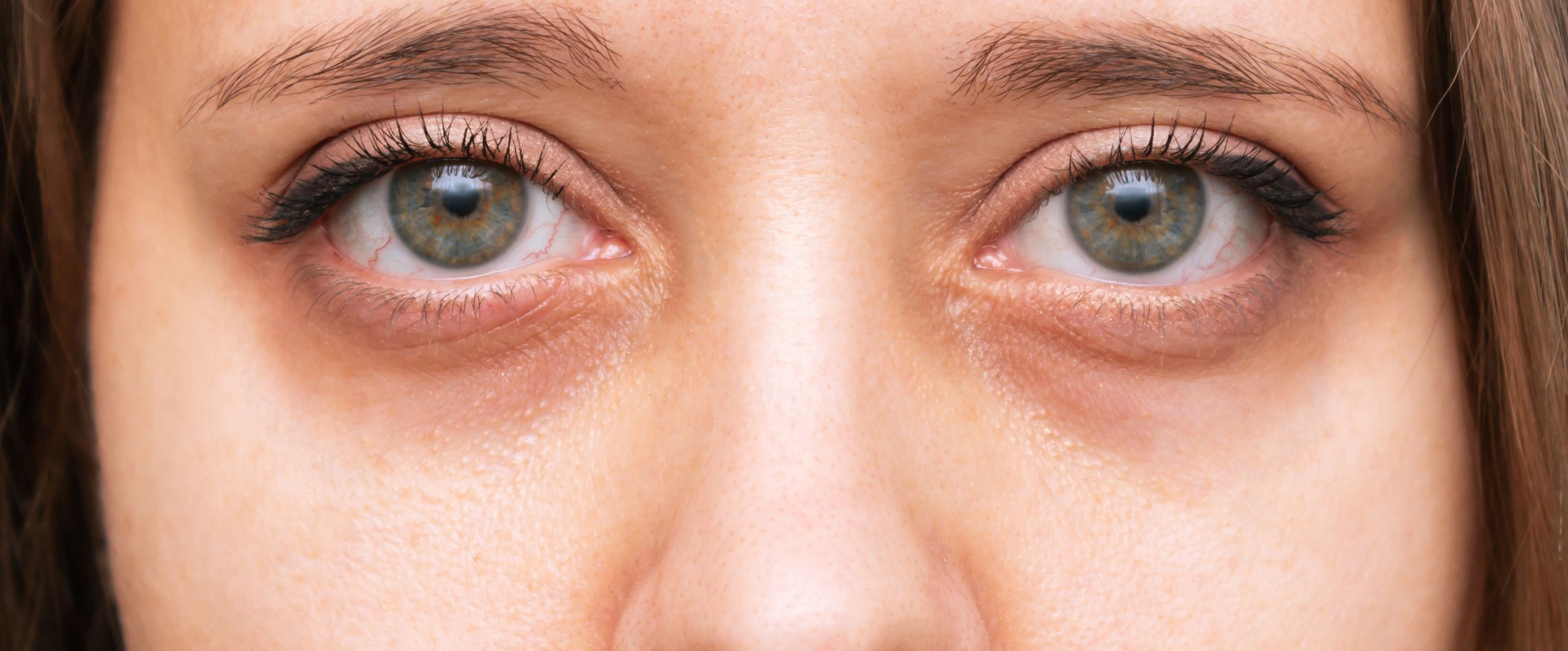 treating dark circles around eyes