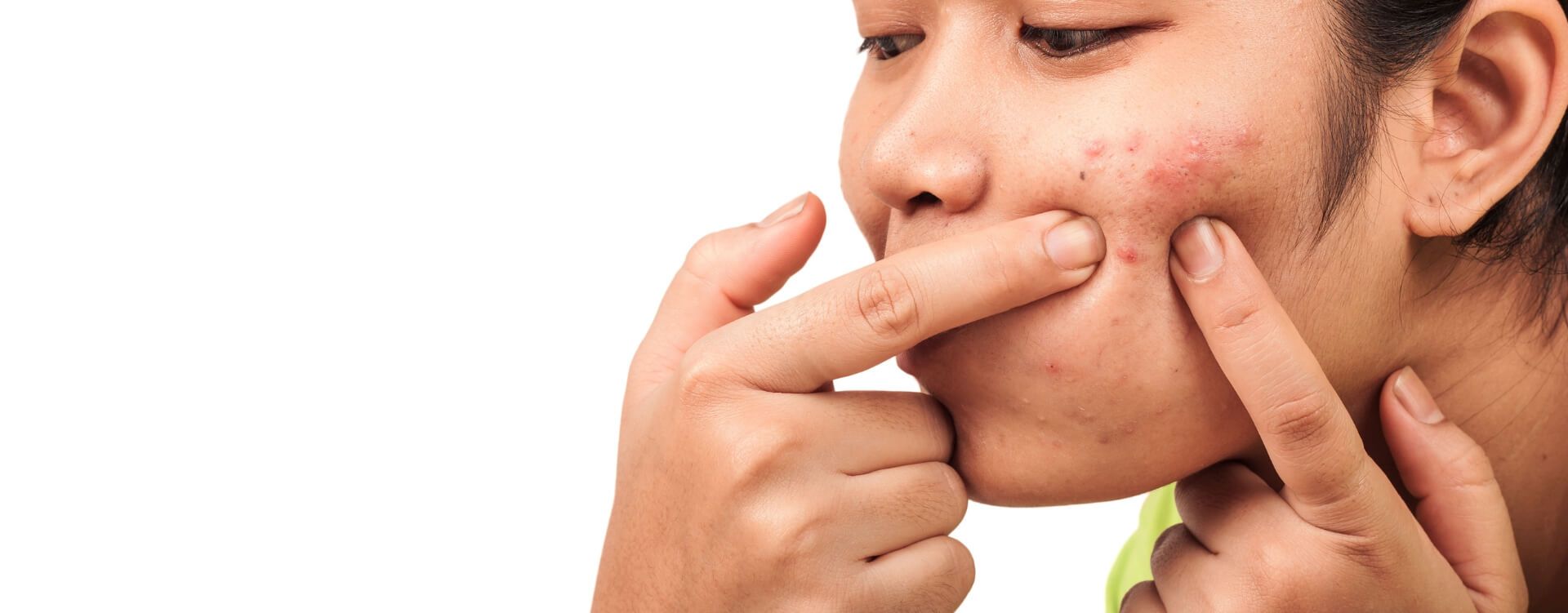 Overcoming Forehead Acne: Tips for Healthy Skin