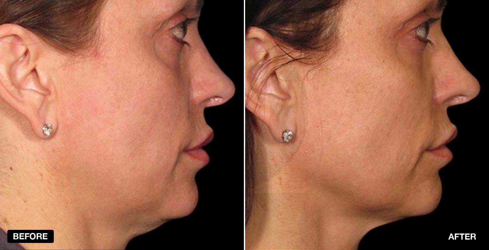 Ultrasound transformations - patient case 1 of 1 at PHI Clinic London