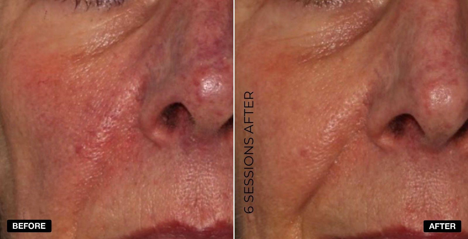 V Beam before and afters - patient case 1 of 5 at PHI Clinic London