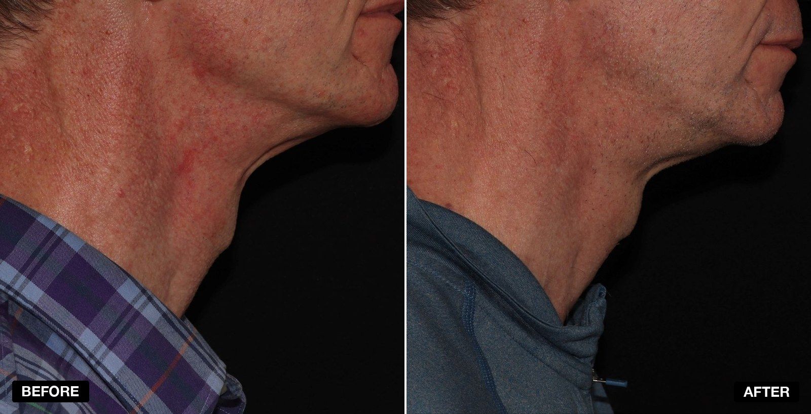V Beam before and afters - patient case 3 of 5 at PHI Clinic London