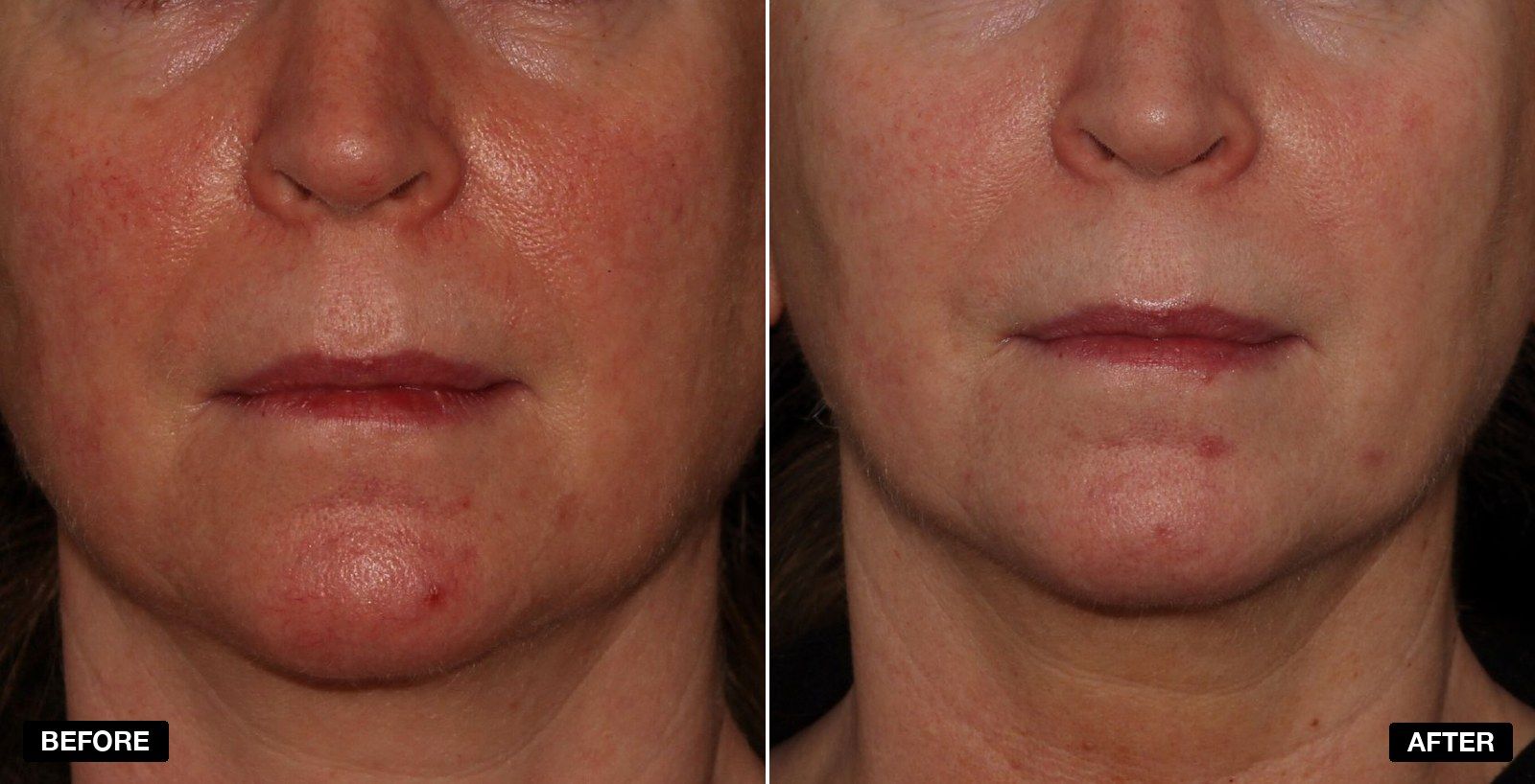 V Beam before and afters - patient case 4 of 5 at PHI Clinic London