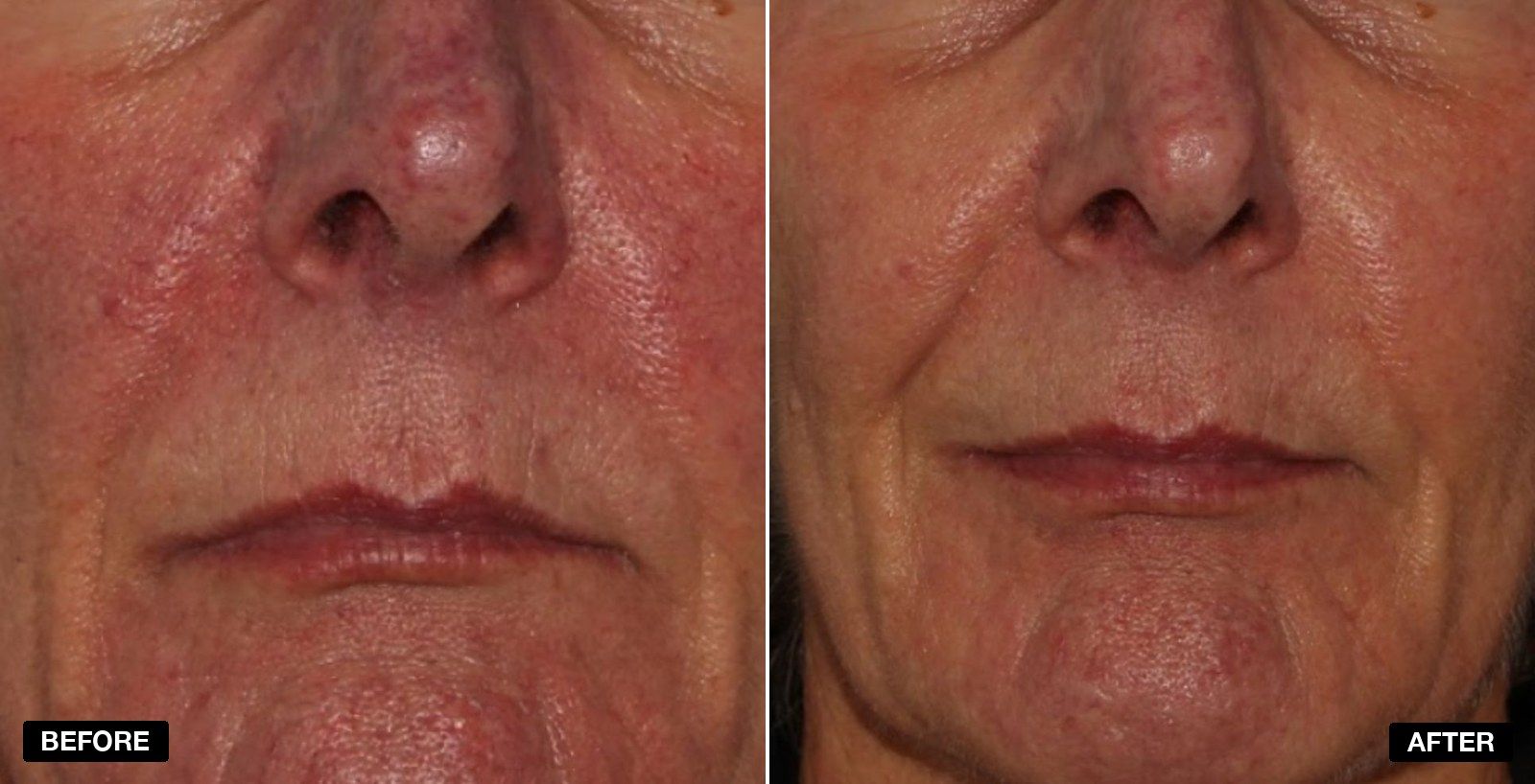 V Beam before and afters - patient case 5 of 5 at PHI Clinic London