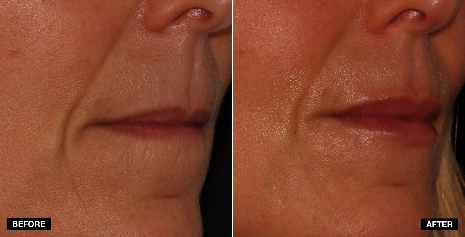 Vertical Lip Lines transformations - patient case 1 of 1 at PHI Clinic London