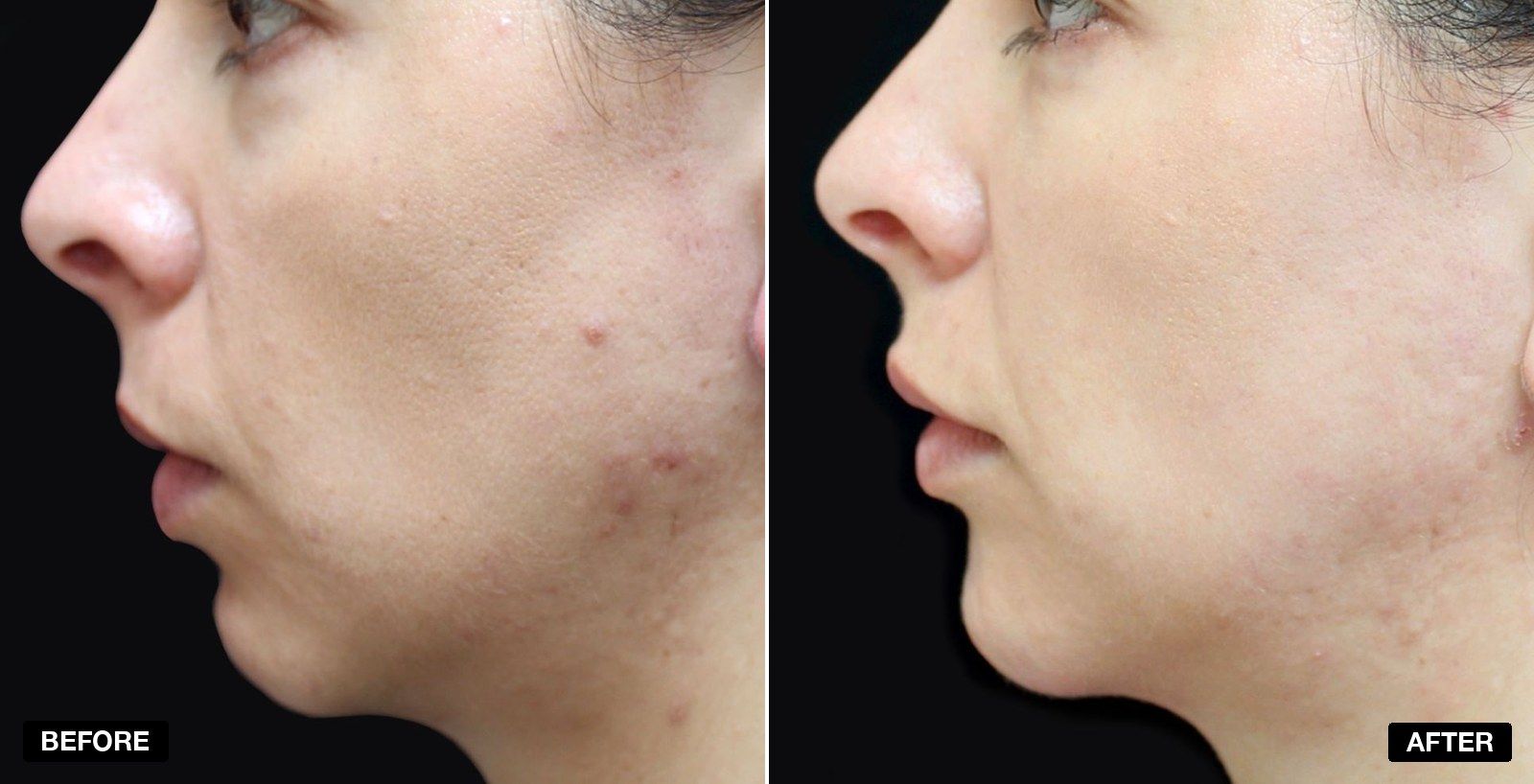 Weak chin transformations - patient case 1 of 1 at PHI Clinic London