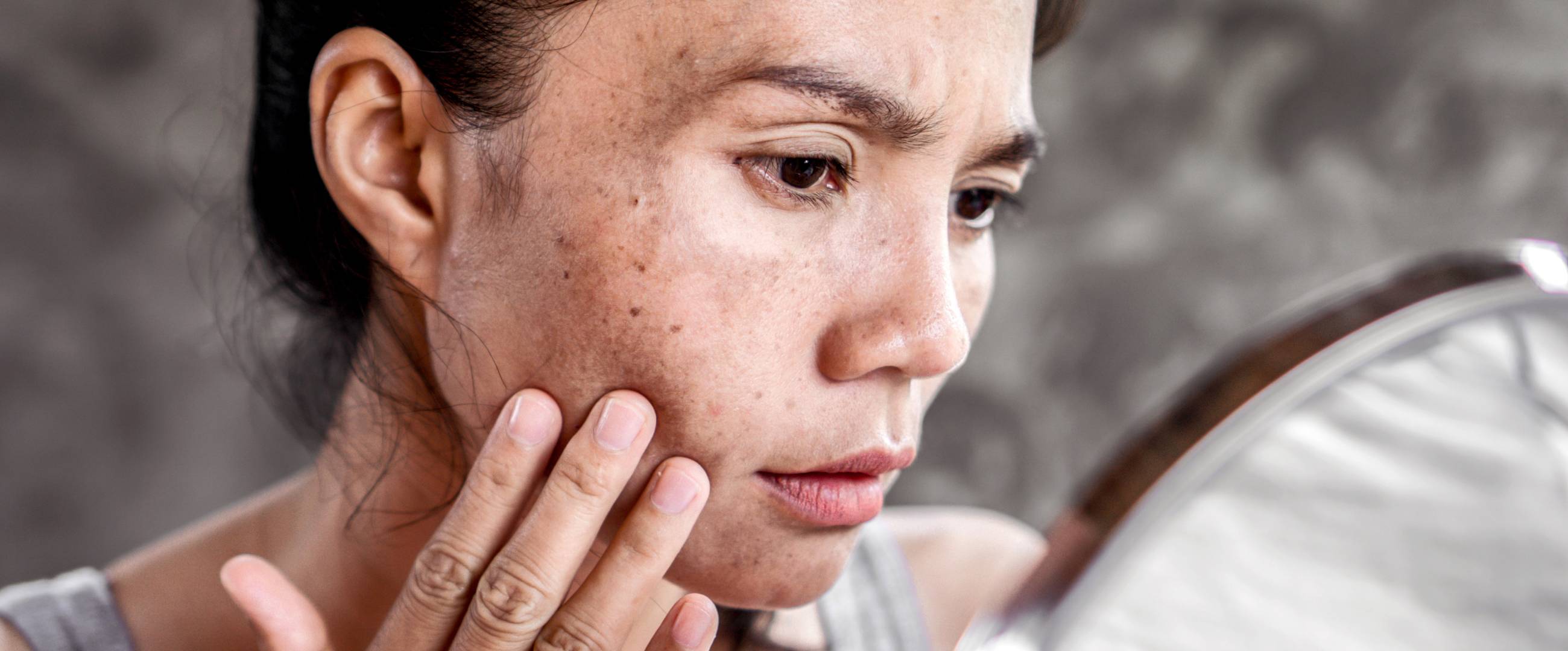 stubborn pigmentation treatment london
