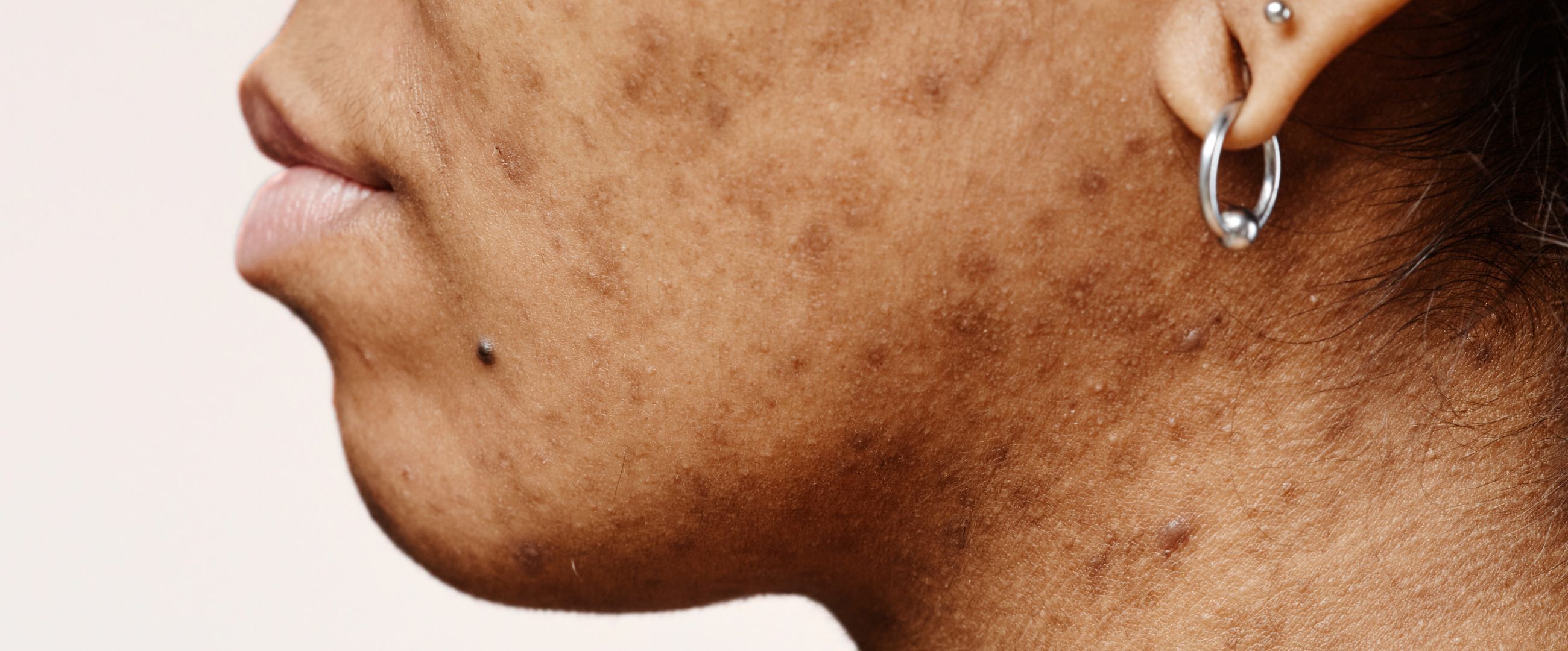 woman with acne scars on face