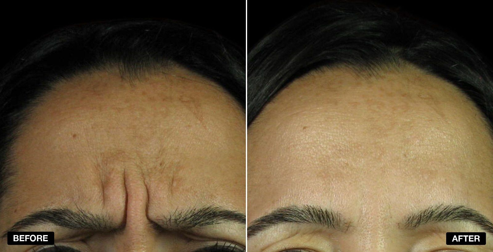 Wrinkles treatment before and afters - patient case 1 of 1 at PHI Clinic London